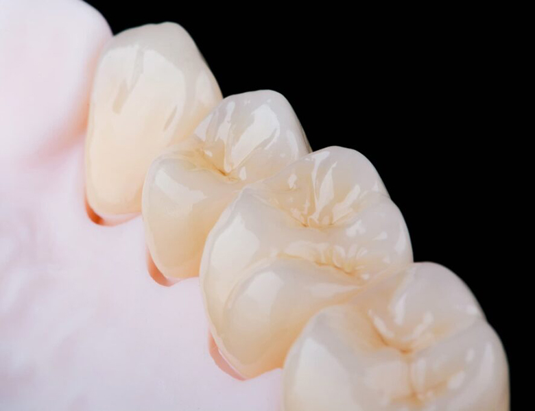 外苑前（東京）の歯医者、Angel総合歯科のセレック(CEREC)治療