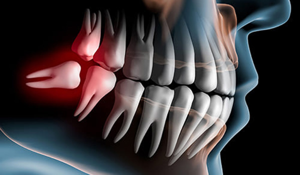 外苑前（東京）の歯医者、Angel総合歯科で歯科用CT精密診断