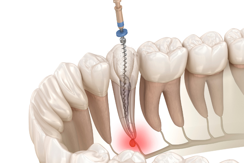 外苑前（東京）の歯医者、Angel総合歯科でマイクロスコープ精密治療