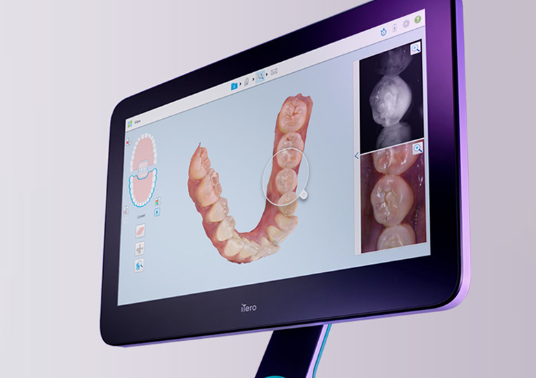 外苑前（東京）の歯医者、Angel総合歯科の口腔内スキャナーiTero(アイテロ)