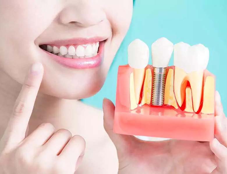 蒲田のインプラント専門医院、のびのび歯科・矯正歯科のインプラントメーカー